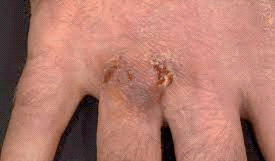 Swimming Pool Granuloma